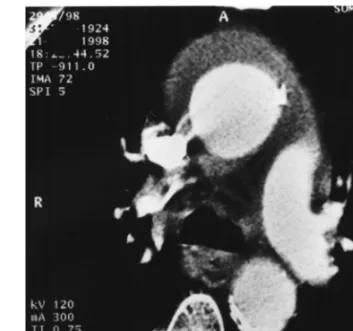 Fig. 1. CT scan showing the large intramural hematoma of the ascending aorta.