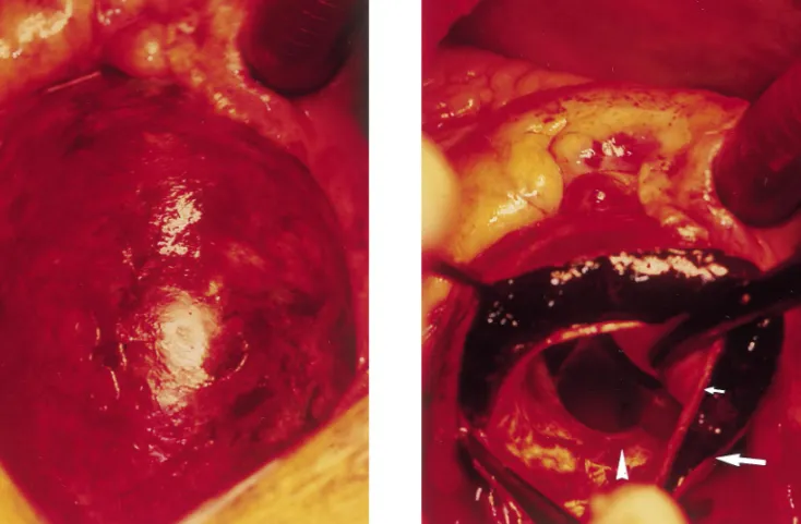 Fig. 2. Intraoperative view of the ascending aorta after sternotomy.