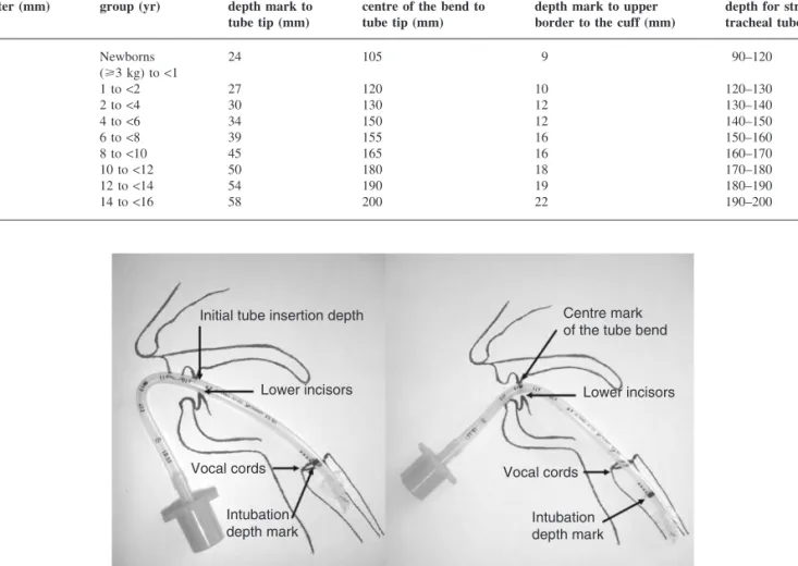 Fig 2 Step A: The oral preformed tracheal tube inserted with intubation depth mark at the level of the cords