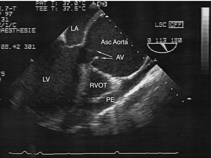 Fig 1 Transoesophageal oblique view of the left ventricular outflow tract. Abbreviations: LA 5 left atrium; LV 5 left ventricle; AV 5 aortic valve; Asc Aorta 5 ascending aorta; RVOT 5 right ventricular outflow tract; and PE 5 pericardial effusion.