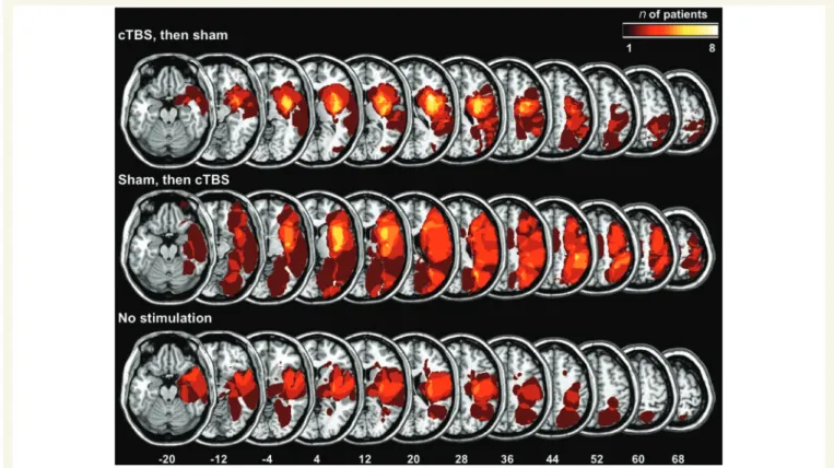 Figure 1 Overlap map showing the degree of involvement of each individual voxel normalized to the MNI template in the lesions of the three groups of spatial neglect patients