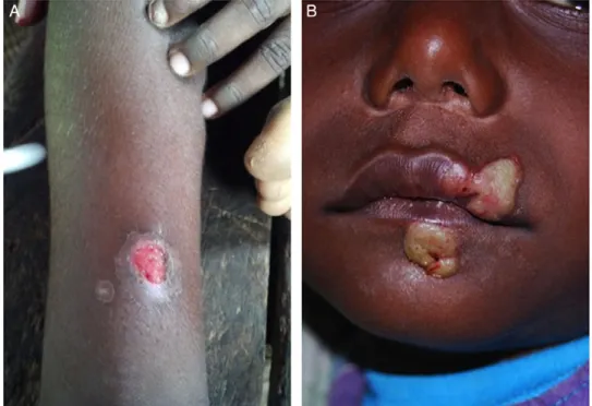 Fig. 2 Lesions of primary yaws. A, typical ulcer of primary yaws. B, papilloma of primary yaws (Images reproduced with permission of M.M
