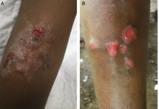 Fig. 3 Skin lesions of secondary yaws. A, Crusted maculopapular lesion of secondary yaws