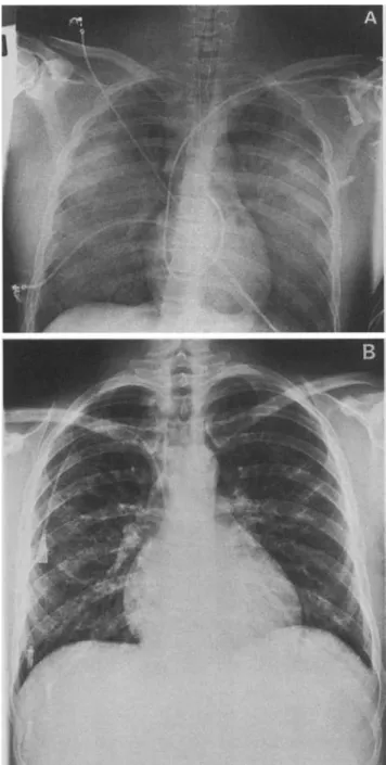 Figure 1. A, Chest roentgenogram obtained on admission, showing intense, diffuse bilateral infiltrates without pleural effusion