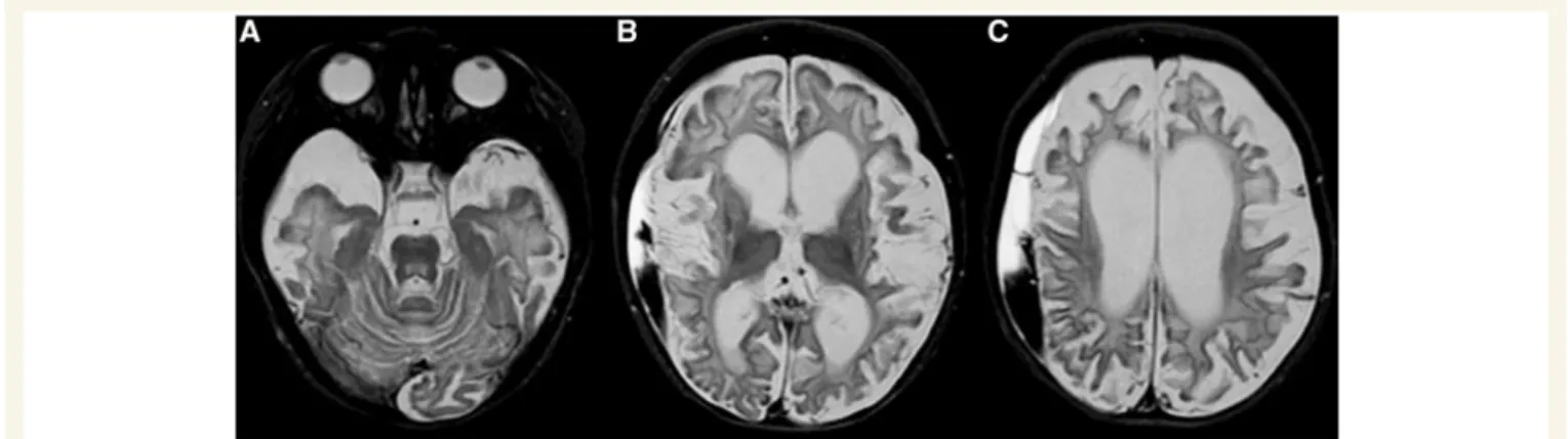 Table 1 SLC19A3 mutations in present patients