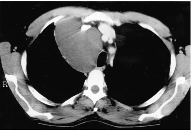 Fig. 1. Computed tomography of the chest. Large cystic lesion localized in the superior anterior mediastinum.