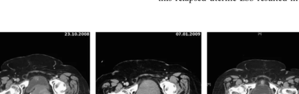 Figure 1. Repeated computed tomography scan conducted at the initiation of imatinib therapy (14 · 9 cm 2 ), 4 and 6 months thereafter, respectively, demonstrating the substantial regression of the endometroid uterine sarcoma (4 · 3 cm 2 ).