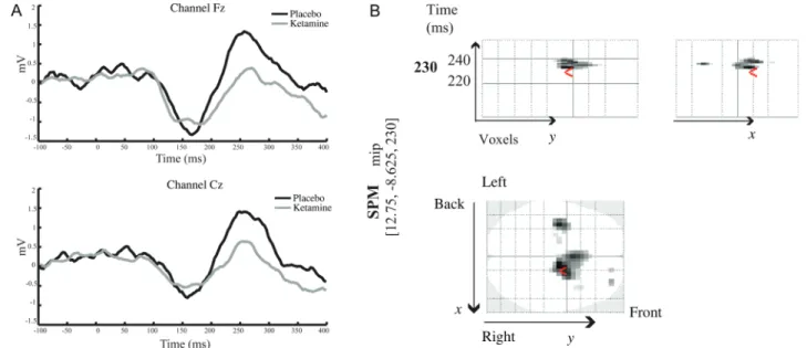 Figure 3. ( A ) Grand average difference MMN waveform in placebo (black line) and ketamine (grey line) conditions across frontal and central electrodes