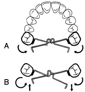 Figure 1 Moments and forces delivered by a transpalatal arch activated for symmetrical (A) and for asymmetrical (B) molar derotation