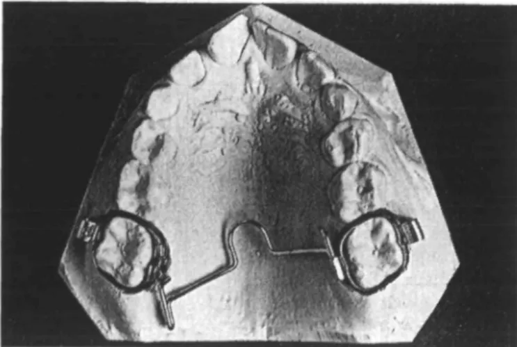 Figure 2 Position of the activated arch when inserted in one molar tube.