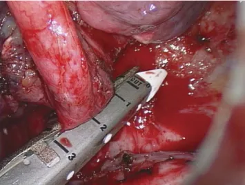 Fig. 2. Aberrant artery (arrow) originating from the thoracic aorta.