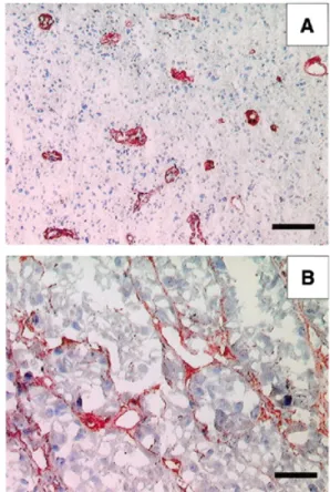 Figure 4. Immunohistochemical experiments with the antibody ME4C. (A) A section of glioblastoma multiforme specimen