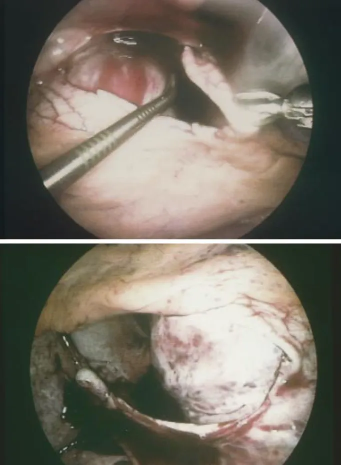 Fig. 1. Video-assisted thoracoscopic pericardial fenestration performed on the left side: the phrenic nerve is visualized and pericardiocentesis is performed under direct vision, (a); the pericardium is grasped with a Duval forceps and incised with Metzenb