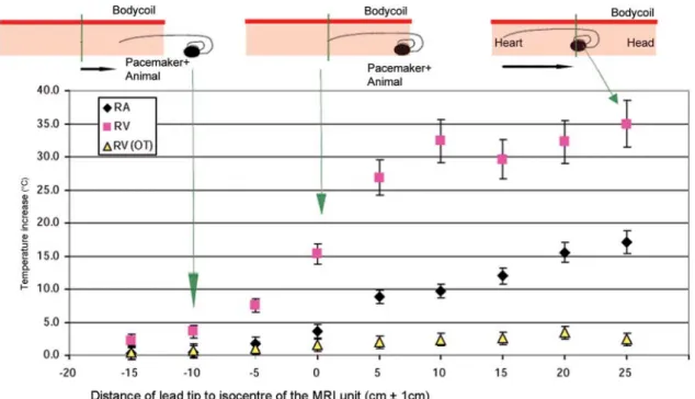 Figure 2 The heating at the lead tip depended strongly on the position of the pacing lead within the body-coil of the MRI unit
