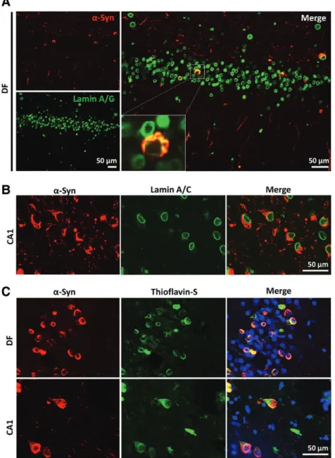 Figure 8. a -Syn G51D from post-mortem human brains is Thioflavin-S positive and partially colocalizes with nuclear envelope proteins