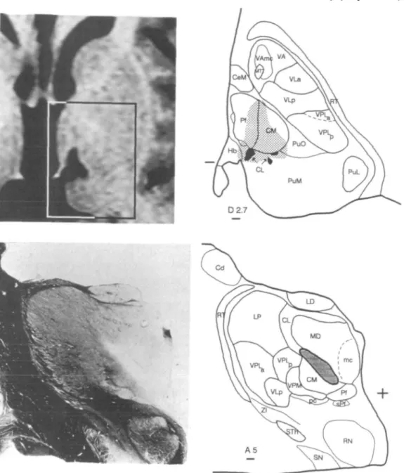 Fig. 1 Upper row: 3 months post-operative gadolinium enhanced MRI (left) and atlas projection (right) of medial thalamic therapeutic lesions in a patient suffering from central neurogenic pain