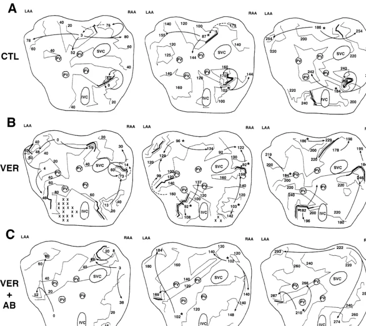 Fig. 2. Activation maps during three consecutive cycles of AF under control conditions (A), in the presence of verapamil, 0.2 mg / kg followed by 1.5 mg / kg / min (B) and in the presence of the same dose of verapamil and autonomic blockade (C)