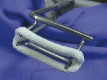 Fig. 2. Intraoperative view after clip (25 mm) deployment on 17 kg female baboon.
