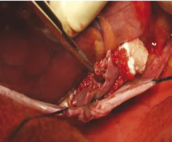 Fig. 3. Intraoperative view after incision of LAA. No LAA perfusion confirmed on the beating heart.