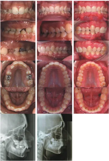 Figure 5  Case with partial treatment (OB &gt; 50% at T2). Angle class II  Division 1, skeletal class II, deep bite with gingival incisor contact, skeletal  normodivergency, spacing in the upper and lower front, lack of space in  the lower arch (left colum