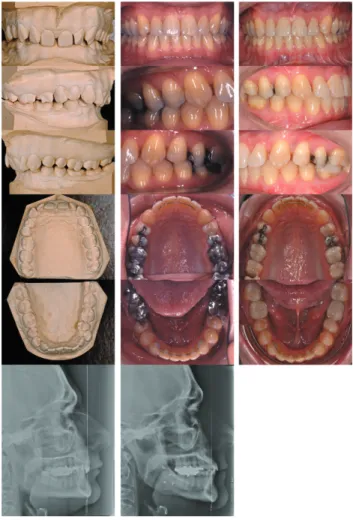 Figure 7  Adult case with long-term stability. Angle class II Division 2,  skeletal class II, deep bite with palatal impingement, skeletal  hypodiver-gency, maxillary and mandibular frontal crowding