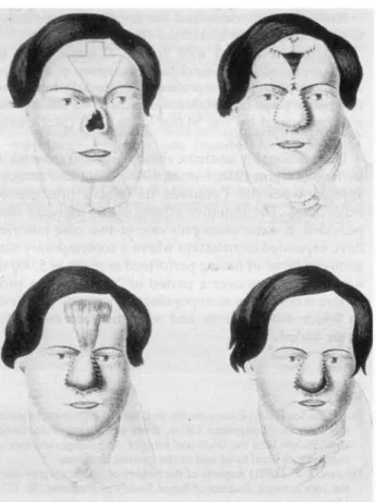 Fig. 3 A central forehead flap <>f the Indian type and WIOKHII iiiHig waMiscdfiT repaii.