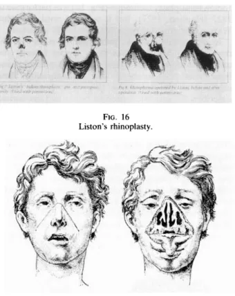 FIG.  16 Liston's rhinoplasty.