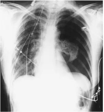 Fig. 1. Left pneumothorax after right single lung transplantation for emphysema.