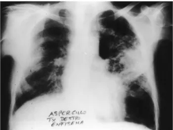Fig. 2. Pulmonary aspergillosis in the native lung after right single lung transplantation for emphysema.