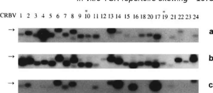 Fig. 1. Southern blot analysis of RT-PCR amplified TCRBV gene TCRBV13–BC PCR products derived from glioblastoma segments from TIL ex vivo (a), after 6 days culture with IL-2 (b) and samples were cloned into PBS-SK 1 vector (Stratagene, La after the second 