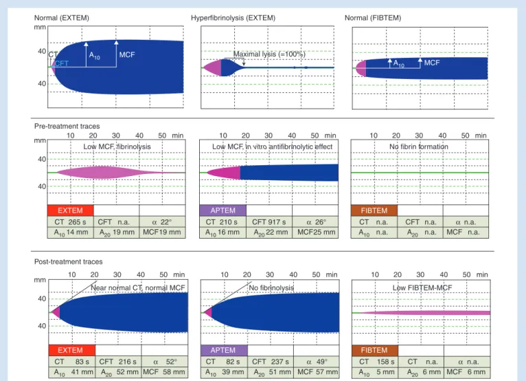 Fig 2 Examples of rotational thromboelastometric tracings. EXTEM reflects the pattern of whole blood clotting, which is triggered by tissue factor.