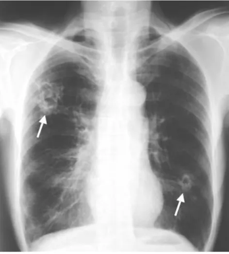 Figure 1. Chest radiograph showing typical cavitating lesions caused by Paragonimus westermani infection