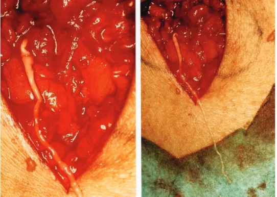 Figure 2. Surgical extirpation of Spirometra erinacei-europaei from the nodular lesion on a patient’s thigh