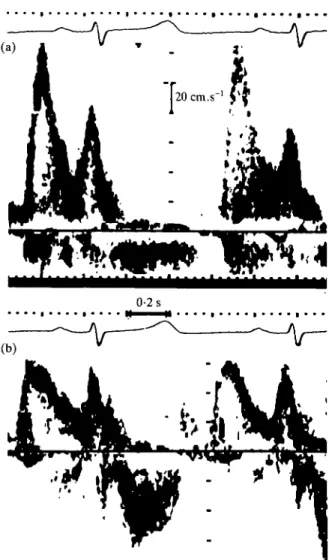 Figure 2 Mitral pulsed Doppler recording from a 39-year-old woman with renal insufficiency before (a) and after (b)  haemo-dialysis