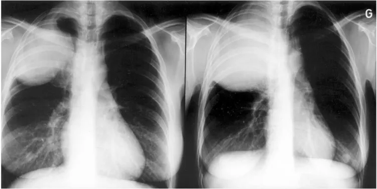 Fig. 1. Chest radiographies of fifth patient in Table 1 demonstrating extremely rapid tumor growth in only 11 days.