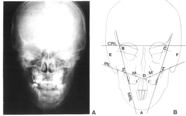 Table 1 describes the expansion gained between the canines and the molars and the total relapse calculated during the retention and postretention periods