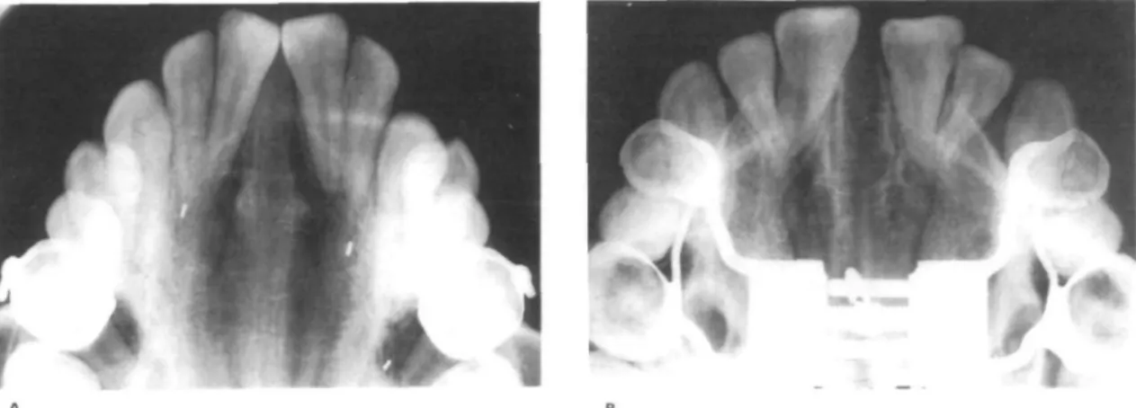 Table 2 Expansion and relapse recorded on P.A. radiographs of group 1 and group 2 (mm)