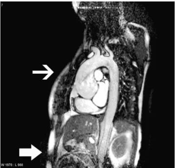 Fig. 1. MRI in diagnosis of acute aortic dissection in a pregnant female in the 36th week of gestation