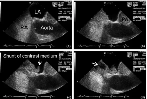 Fig. 1 Trans-oesophageal contrast echocardiography (TEE) for the detection of patent PFO
