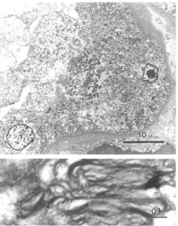 Fig. 3. Kidney transplant (EM x 900, inset x 83 700). Formalin fixed and refixed in glutaraldehyde