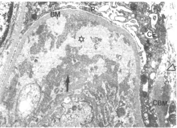 FIG. 8. Glomerular capillary loop with a large subendothelial deposit The strongly osmiophilic parts of the deposit  ( ^ ) exhibit a crystalloid structure, the more translucent central parts (*) are amorphous (sign of a deposit dissolution?)