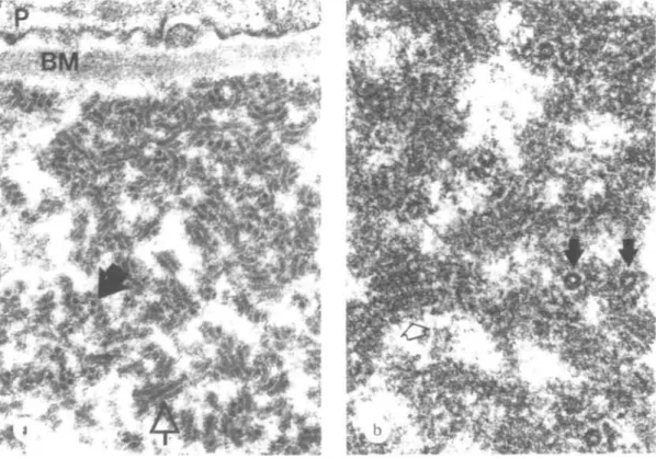 FIG. 10. Crystalloid structure of deposit in the glomemlus (a) and identical structure in the in vitro cryoprecipitate (b) of the same patient