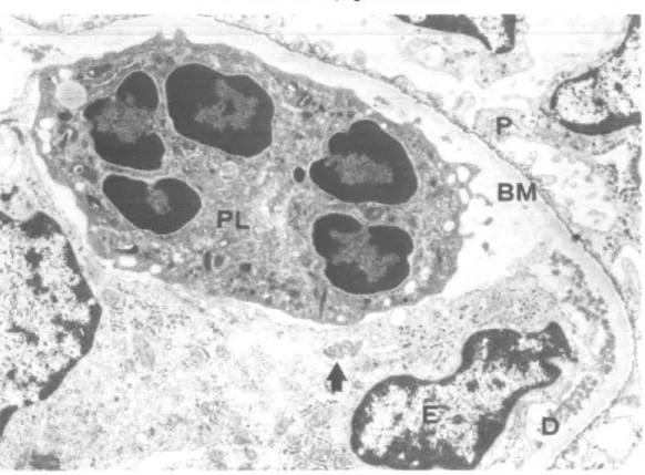 FIG. 11. Glomerular capillary loop with numerous subendothelial deposits (D). A poly- poly-morphonuclear leukocyte (PL) lying immediately upon the basement membrane and an activated endothelial (?) cell (E) are possibly engaged in deposit phagocytosis  ( ^