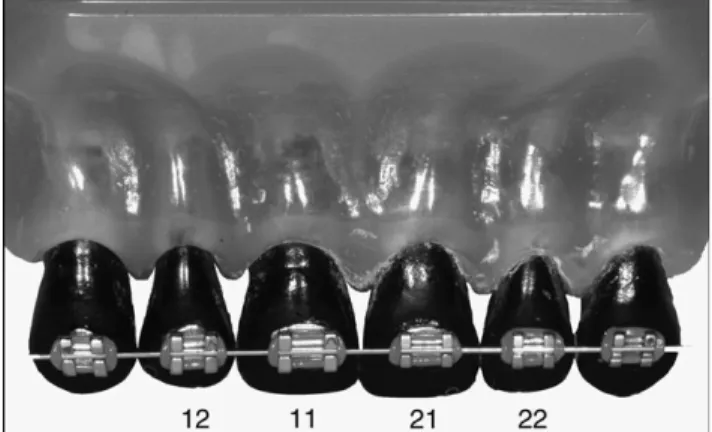 Table 2       Percentage and inter quartile range (IQR) of untouched  (uncleaned) tooth surfaces of teeth 12, 11, 21, and 22