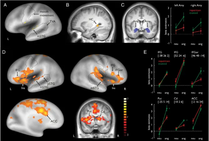 Figure 2. ( A ) Repeated compared with evoked production of prosody revealed activity in the left mSTG located within the TVA