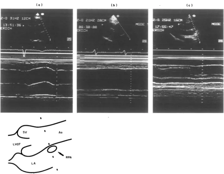 Figure 1 Still frames of 2-D echocardiography (upper panels) from the parasternal long-axis view in three patients (frames (a) (b) and (c)) and the corresponding target M-mode recordings (lower panels)