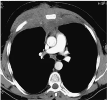 Fig. 1. CT scan of the thorax of the 55-year-old man with Langerhans cell histiocytosis of the mediastinum