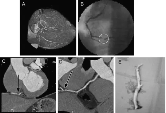 Fig. 6. Significant lesion in the middle segment of the RCA demonstrated in the VRT image (A, arrow) and ICA (B, circle)