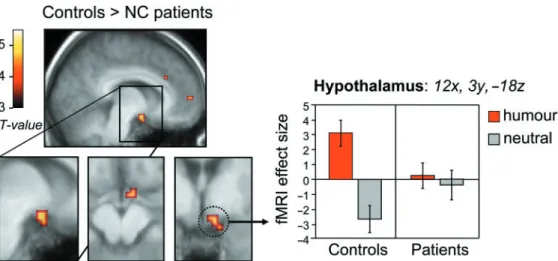 Fig. 3 Increased amygdala response to humour in NC patients compared to controls. Parameter estimate showed increased fMRI signal to humourous sequences in the patients but not in the controls