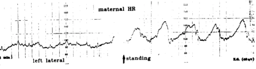 Fig. 1 - Recording of maternal beat-to-beat heart rate in left lateral and standing postures in late preg- preg-nancy (40 2/7 weeks)